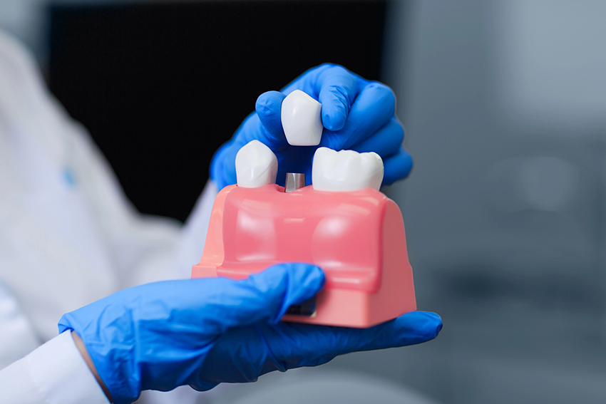 5 Reasons Dental Implants Are the Best Solution for Missing Teeth