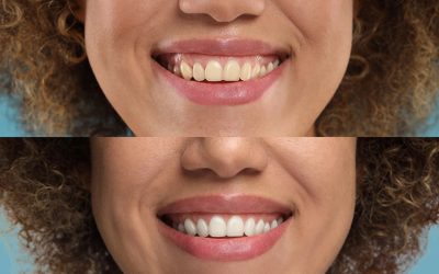 Tooth Whitening FAQs: What to Know Before Brightening Your Smile