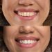 Tooth Whitening FAQs: What to Know Before Brightening Your Smile