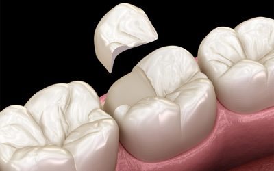 Not Every Tooth Needs a Crown: When an Inlay or Onlay Is the Better Option